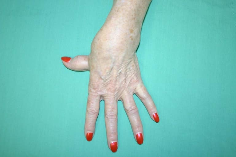 Arthritis Older hand with red painted nails on a turquoise background